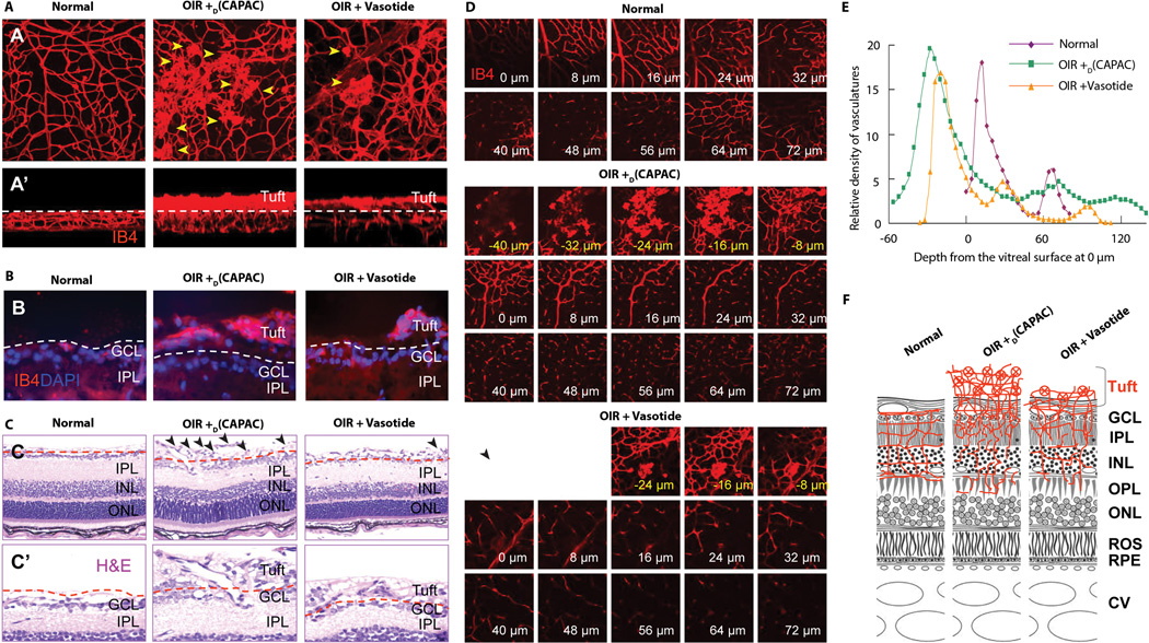 Vascular tufts in OIR mice extend from the retina into the vitreous. (A) IB4-stained branched vessels and tufts in horizontal retinal scans in normal mice and mice with oxygen-induced retinopathy (OIR) treated with D(CAPAC) control peptide or Vasotide. (A’) Scans rotated 90°, showing tufts above dashed lines, innermost retina below. Sci Transl Med. 2015 Oct 14;7(309):309ra165.